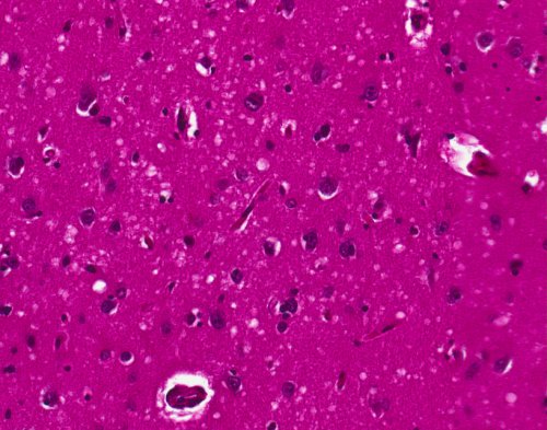 When she was 23, a lab worker pricked her thumb in an experiment with prion-infected mice. She died 10 years later | Boing Boing