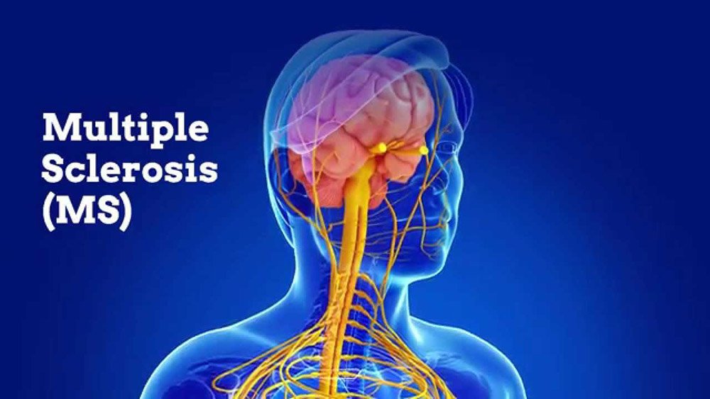 Multiple Sclerosis Natural Treatment: 10 Powerful Herbs