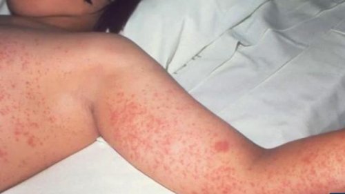 Fact check: Robert F. Kennedy Jr. says measles infection may have benefits