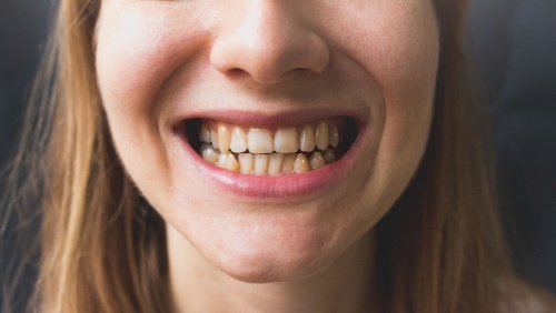 What is ‘Ozempic Teeth’? The Truth About the Rapid Weight Loss Treatment’s ‘Damaging’ Side Effects