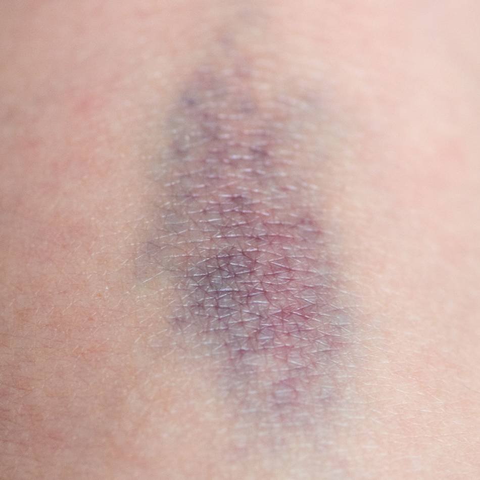 Hämophilie: Große blaue Flecken? Dahinter kann eine Erkrankung stecken