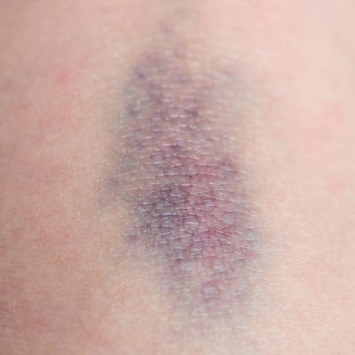 Hämophilie: Große blaue Flecken? Dahinter kann eine Erkrankung stecken