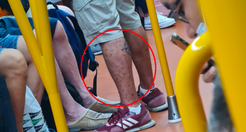Disturbing monkeypox photo on train prompts warning over virus myth
