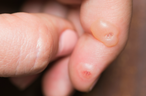 El virus detrás de las verrugas en los dedos puede mutar en cáncer