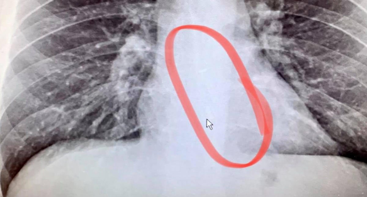 Disturbing discovery in man's chest x-ray after he suffers a dry throat