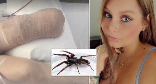 Sydney woman's leg amputated after 'harmless' spider bite