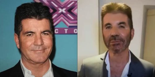 Plastic Surgery Expert Explains Why Simon Cowell's Face Is 'Melting ...