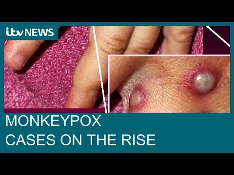 Monkeypox could have ‘massive impact’ on sexual health services, doctor warns | ITV News