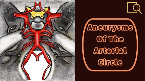 Aneurysms Of The Arterial Circle