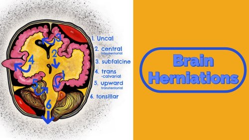 Brain Herniations and Raised ICP