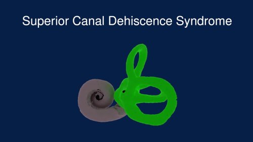 Superior Canal Dehiscence Syndrome (SCDS)
