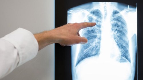 Krankheiten: Erneut Tuberkulose-Fälle in Chemnitz