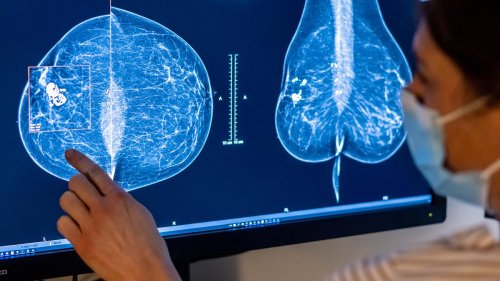 Krebsvorsorge: Kostenlose Brustkrebsvorsorge künftig für Frauen bis 75 Jahren möglich