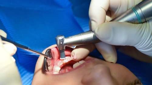 Zahngesundheit: Experte: Corona-Pandemie kostet Kinderzähne