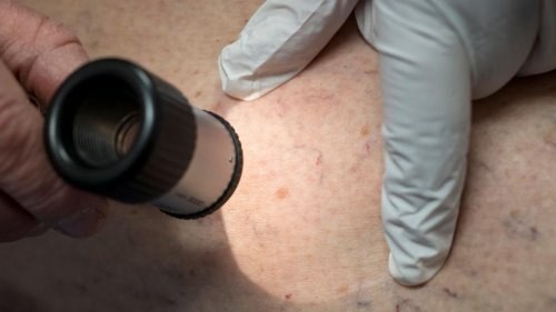 Langzeitschäden durch UV: Wesentlich mehr in Kliniken behandelte Hautkrebsfälle